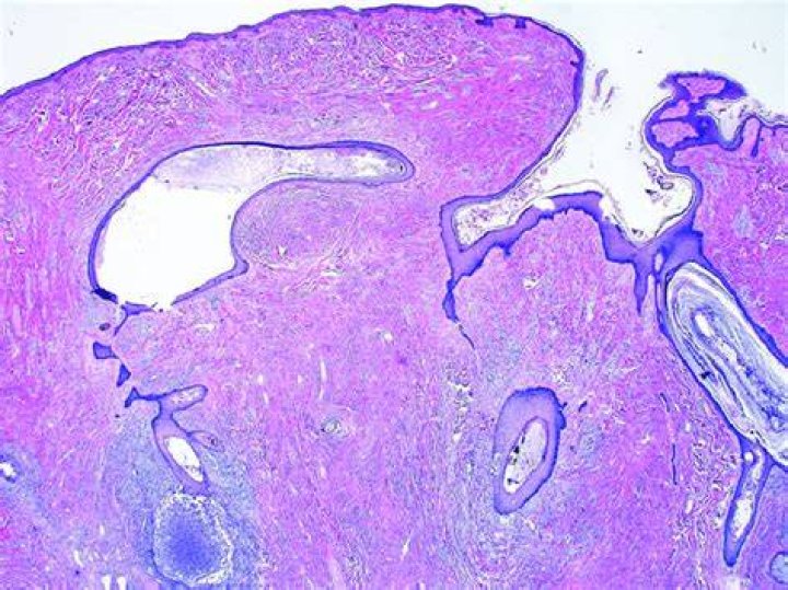 Are Exophytic cysts cancerous?