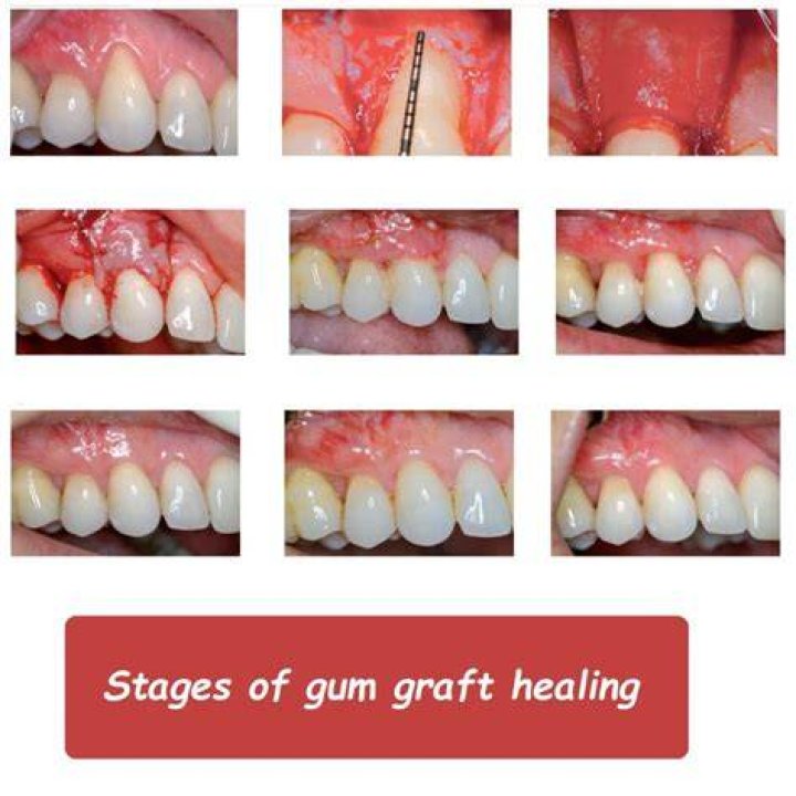Are you awake during a gum graft?