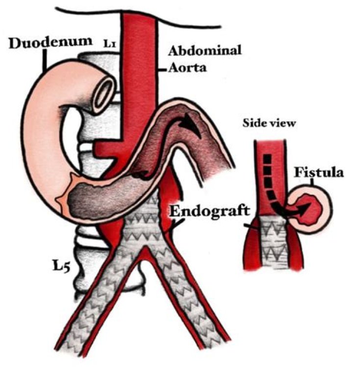 At which portion of the gastrointestinal system is an Aortoenteric fistula most likely to occur for patients with a history of an aorta graft placement?