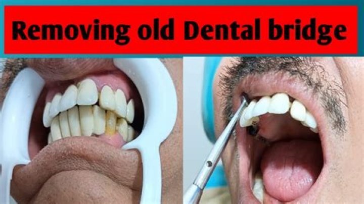 Can an old dental bridge be replaced?
