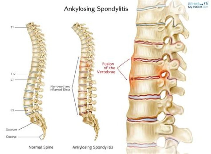 Can ankylosing spondylitis cause a pinched nerve?