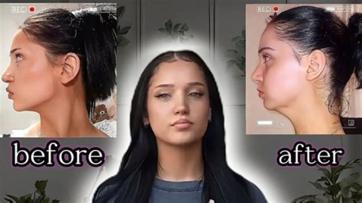 Can braces ruin your face?