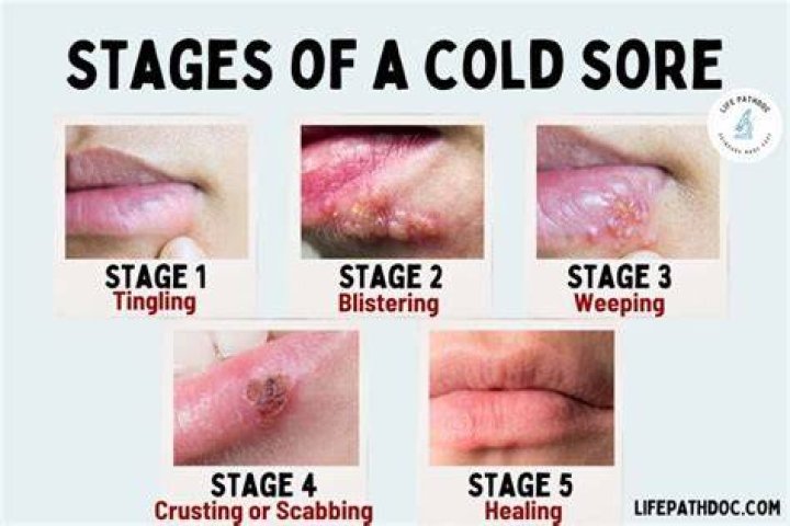 Can cold sores spread to eyes?