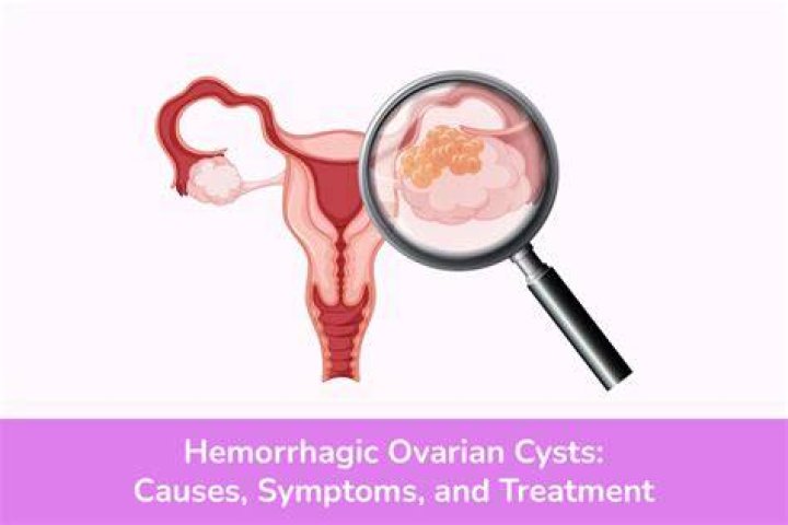 Can hemorrhagic ovarian cysts be cancerous?