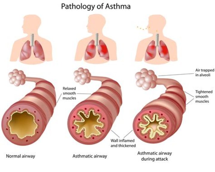 Can pollen in the air cause asthma?