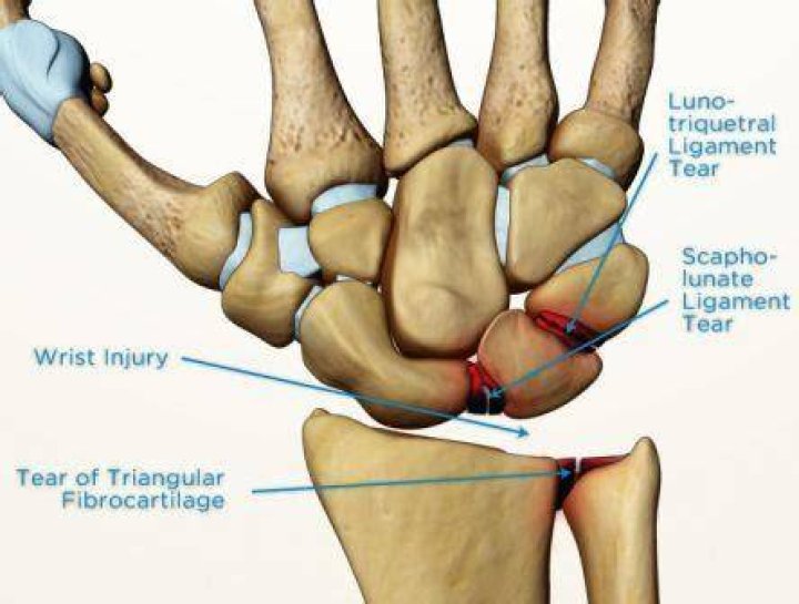 Does a scapholunate tear need surgery?