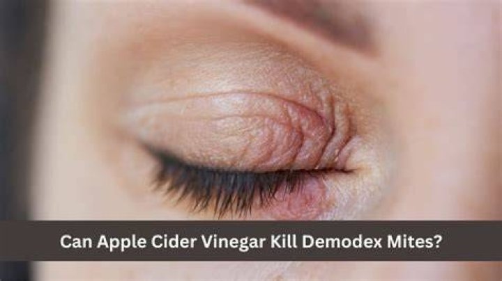 Does apple cider vinegar kill onychomycosis?