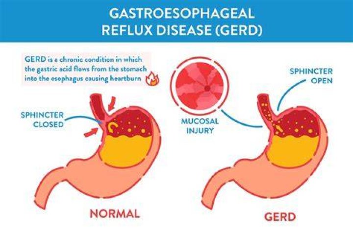 Does GERD cause lightheadedness?