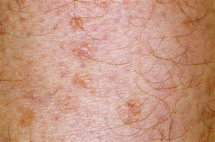 Does methotrexate cause rash on face?