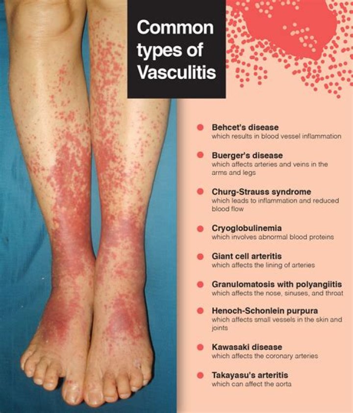 How do you classify vasculitis?