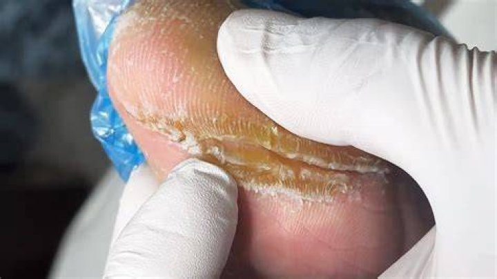 How do you get rid of dead skin between your toes?