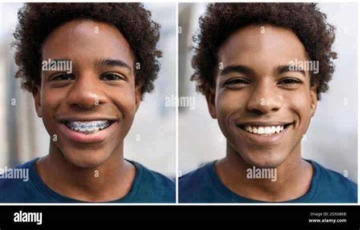 How do you smile without showing braces?