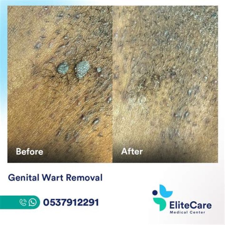 How do you treat recurrent genital warts?