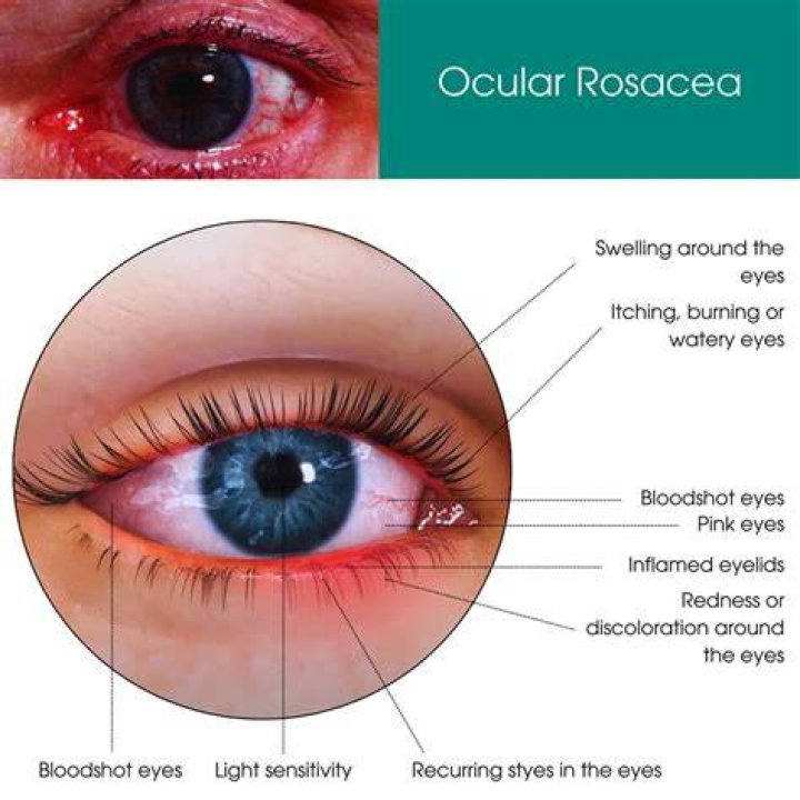 How do you treat rosacea around the eyes?
