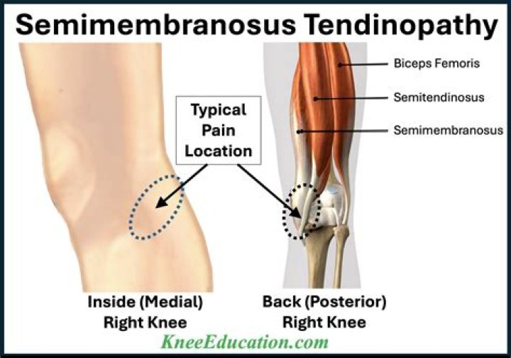 How do you treat Semimembranosus bursitis?
