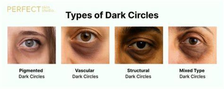 How do you treat vascular dark circles?