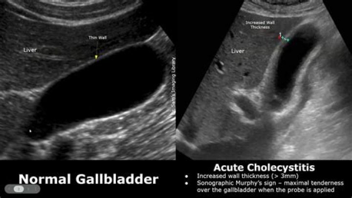 How is cholecystitis diagnosed on ultrasound?