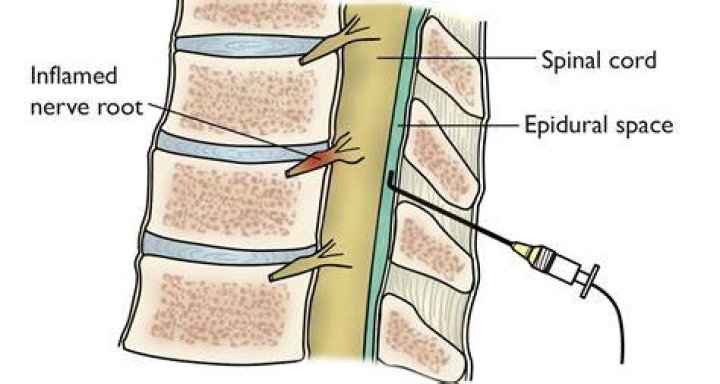 How long does an epidural spinal injection last?
