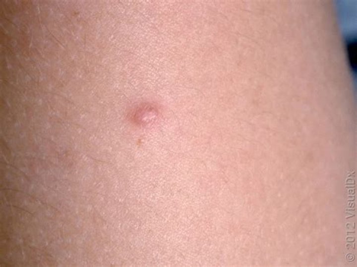 How much does it cost to remove dermatofibroma?