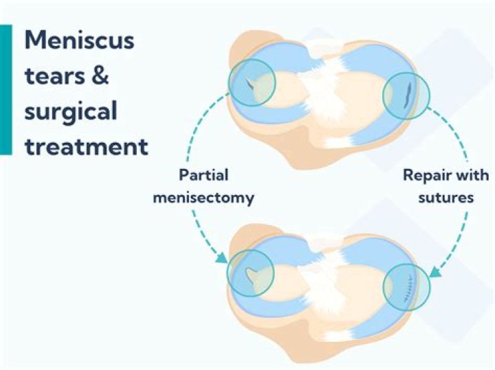 How painful is a meniscus surgery?