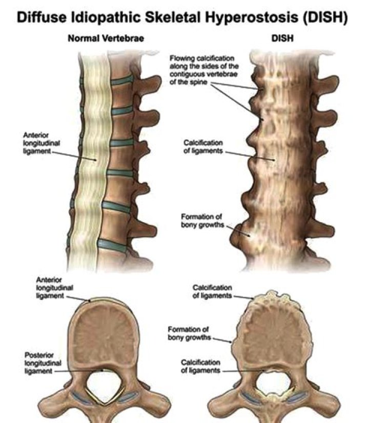 Is Diffuse idiopathic skeletal hyperostosis curable?