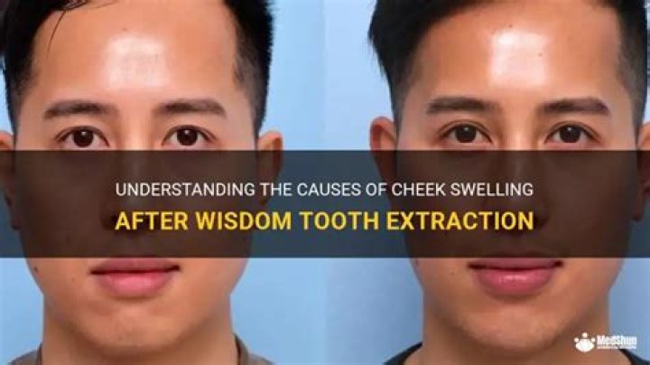 Is it normal for cheek to swell after tooth extraction?