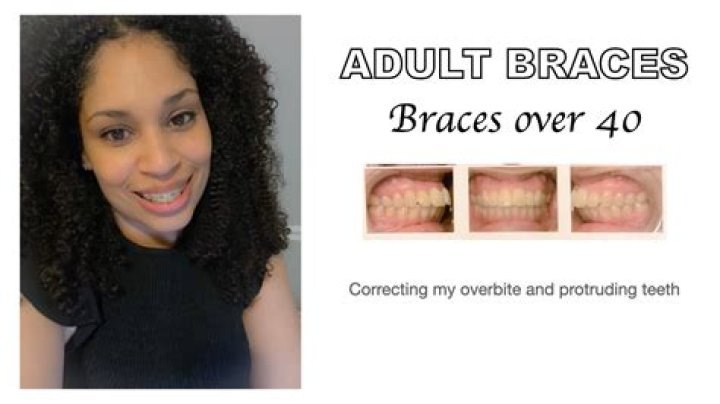 Is it weird for an adult to get braces?