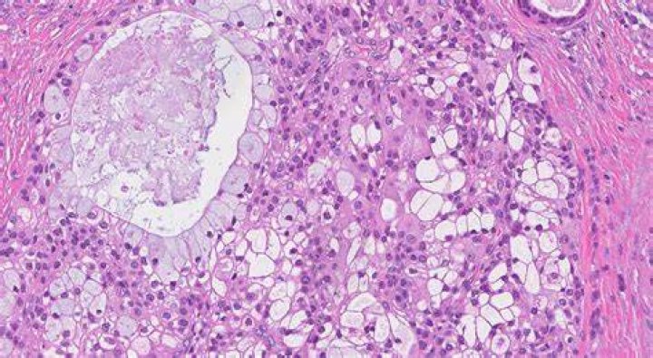 Is mucoepidermoid carcinoma curable?