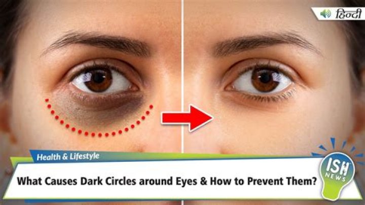 What am I lacking if I have dark circles under my eyes?