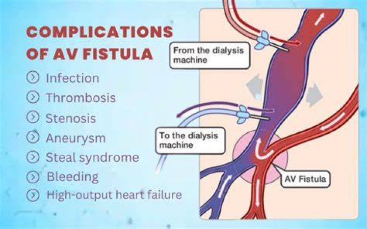 What are the complications of an arteriovenous fistula?