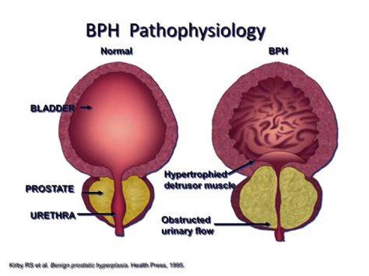 What are the management of BPH?