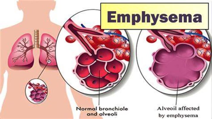 What are the possible lifestyle impacts of emphysema?