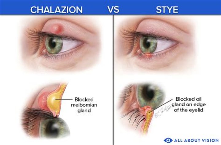 What causes chalazion cysts?