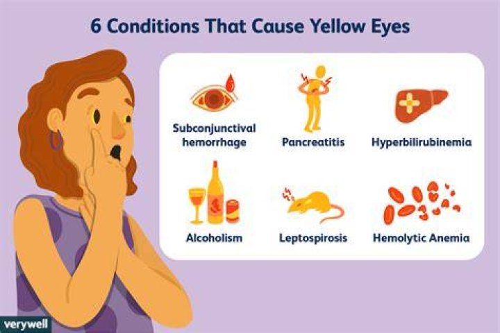 What causes eyes to turn yellowish?