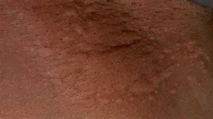What do HIV bruises look like?