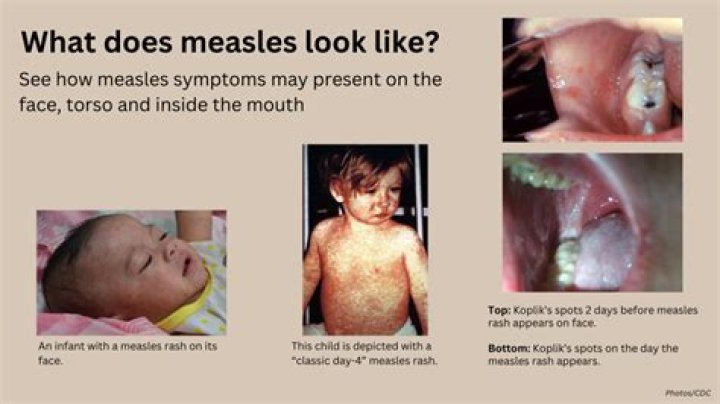 What does a mild case of measles look like?