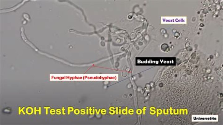 What does a positive KOH test indicate?