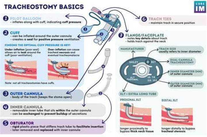 What does a pulsating Trach mean?