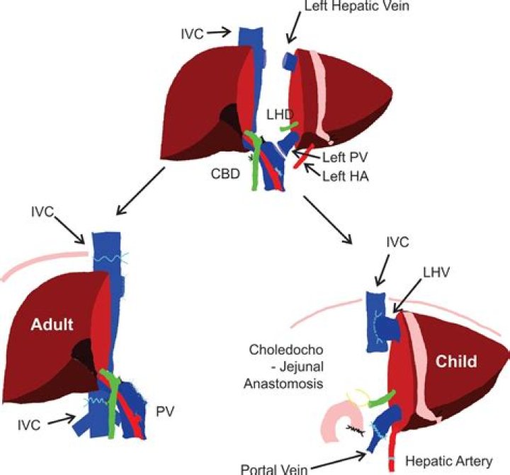 What hospitals do living donor liver transplants?