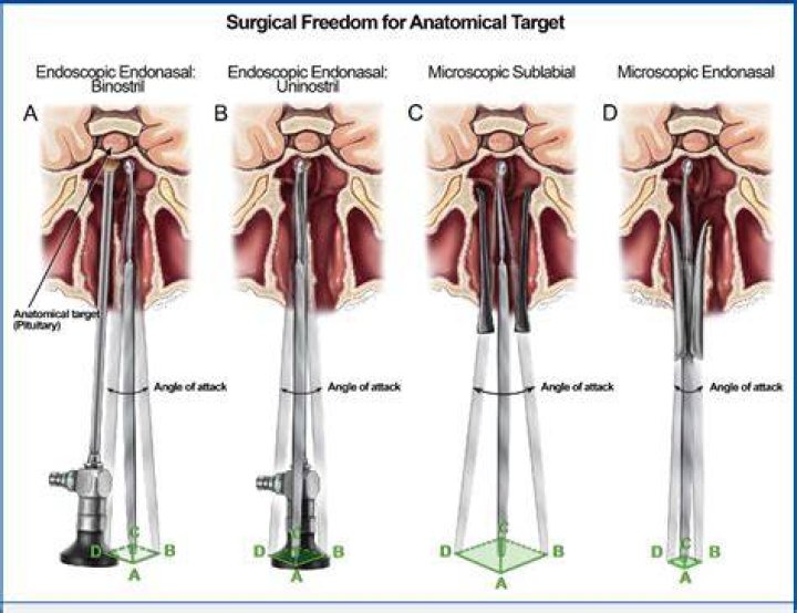 What is a Transsphenoidal Adenomectomy?