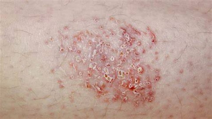 What is a vesicular rash?
