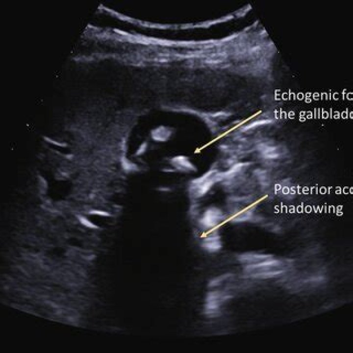 What is echogenic focus in gallbladder?