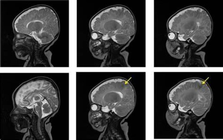 What is focal cortical defect?