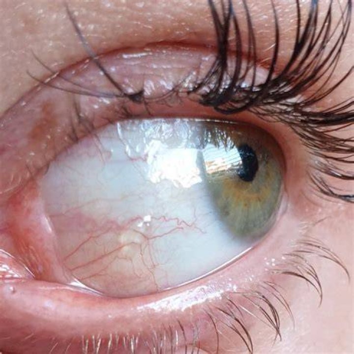 What is the clear bubble on my eye?