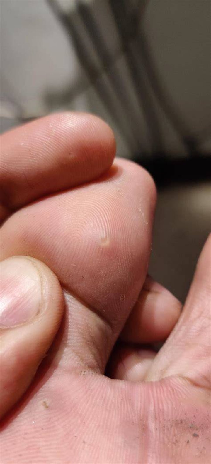 What is the little hard spot on my foot?