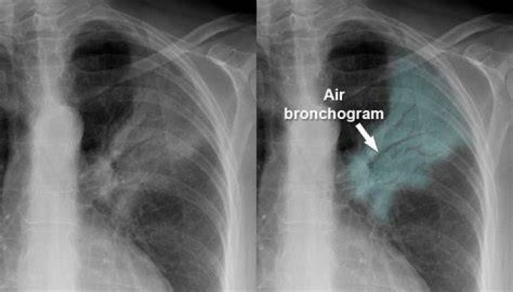 What is the meaning of Bronchogram?