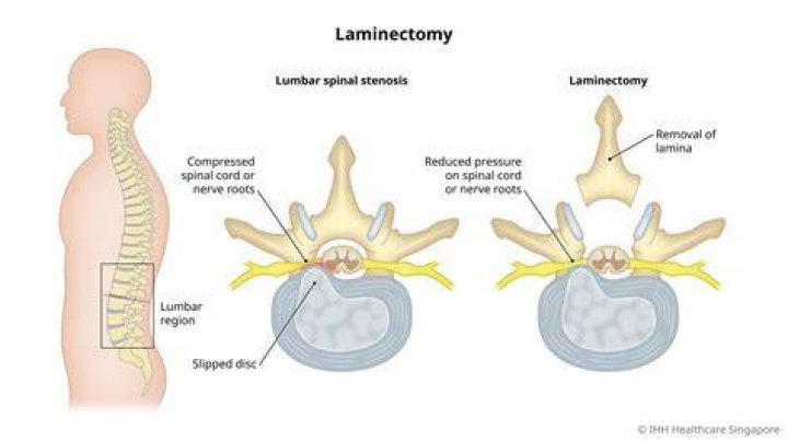 What is the root word for laminectomy?