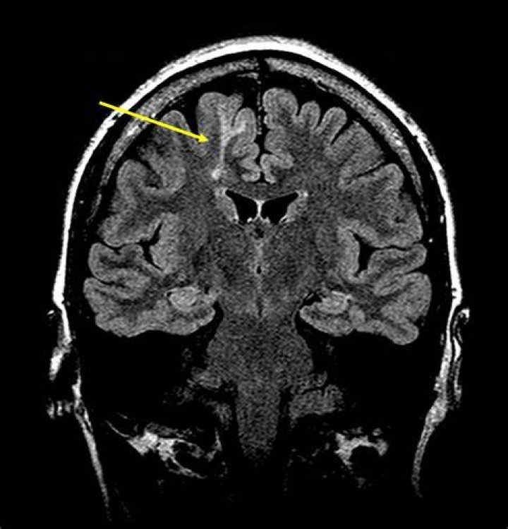 What is Transmantle cortical dysplasia?