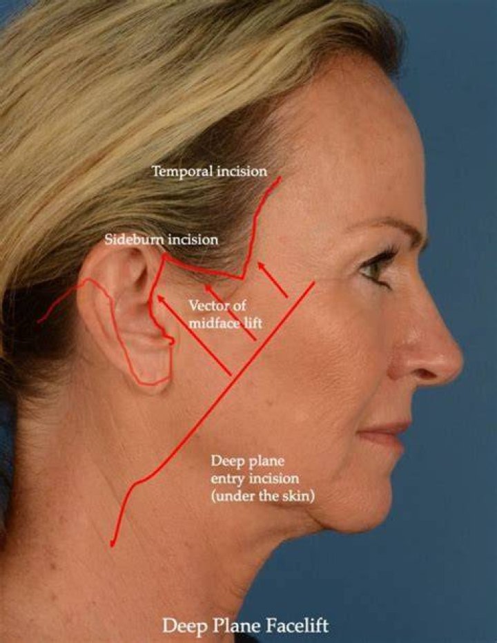 Where are the incisions for a lower facelift?